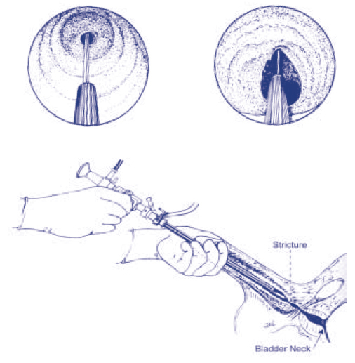 Bladder Neck Incision (B.N.I.) and Urethrotomy, stream means kya