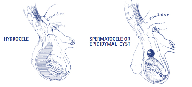 Hydrocelectomy Spermatocelectomy Epididymal Cystectomy Our