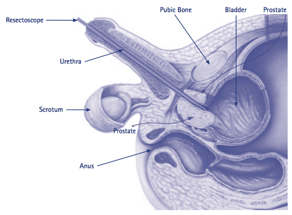 Laser Prostatectomy Our Services Urology Bay of Plenty