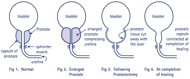 Bladder Neck Incision (B.N.I.) and Urethrotomy, Our Services