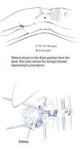 Laparoscopic Nephrectomy, Our Services