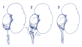 Bladder Neck Incision (B.N.I.) and Urethrotomy