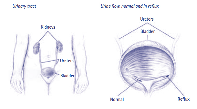 Bladder Neck Incision (B.N.I.) and Urethrotomy