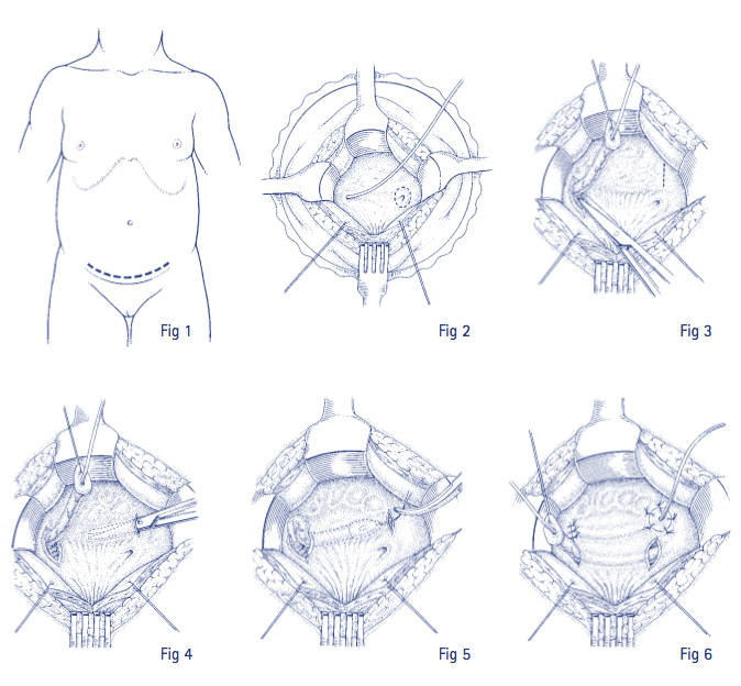 Bladder Neck Incision (B.N.I.) and Urethrotomy